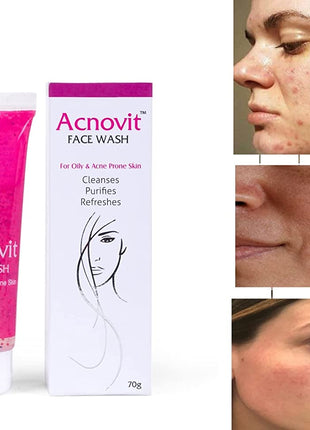 Acnovit facewash for oily & acne prone skin ( 70 ml )