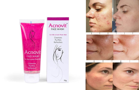 Acnovit facewash for oily & acne prone skin ( 70 ml )