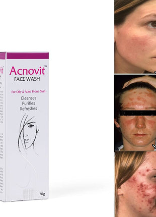 Acnovit facewash for oily & acne prone skin ( 70 ml )