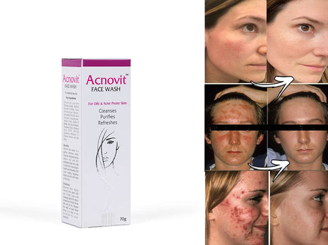 Acnovit facewash for oily & acne prone skin ( 70 ml )