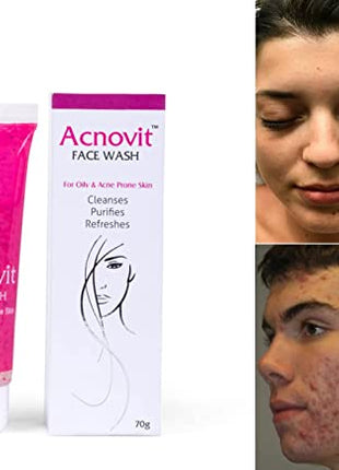 Acnovit facewash for oily & acne prone skin ( 70 ml ) (PACK OF 2)