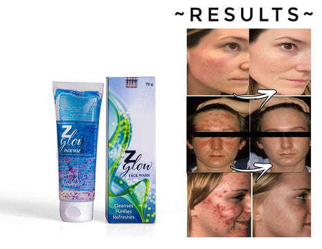 Z Glow facewash for oily & acne prone skin (70 gm)