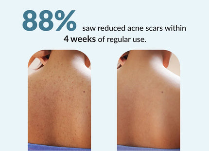 Salyzap Body Wash for Body Acne | Salicylic Acid Body Wash, 2% Salicylic acid, 1% Azelaic acid, 0.1% Tea tree oil