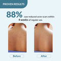 Salyzap Body Wash for Body Acne | Salicylic Acid Body Wash, 2% Salicylic acid, 1% Azelaic acid, 0.1% Tea tree oil